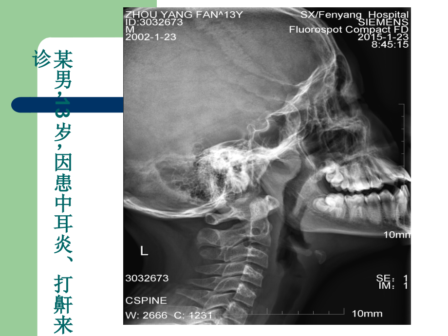 腺样体增大的X线测量与诊断.ppt_第2页