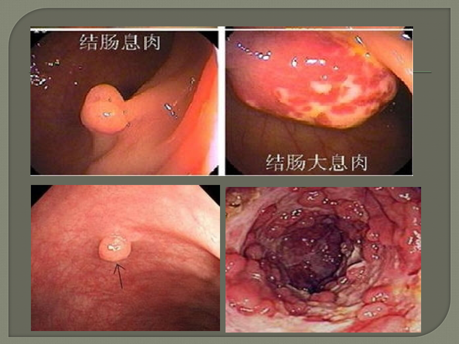 教学查房结肠息肉.ppt_第2页