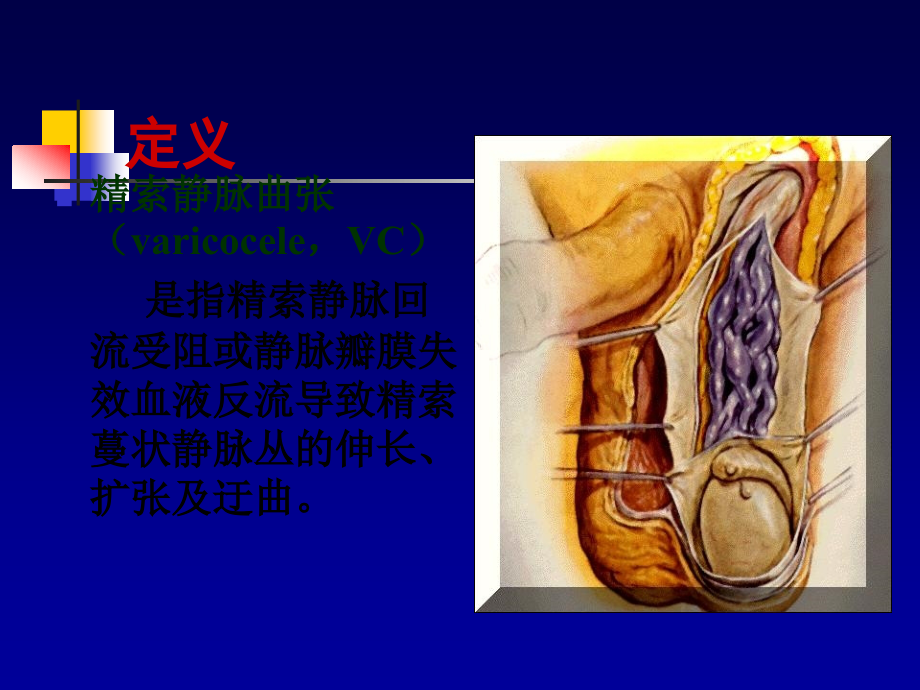 精索静脉曲张诊断治疗及护理ppt课件.ppt_第2页