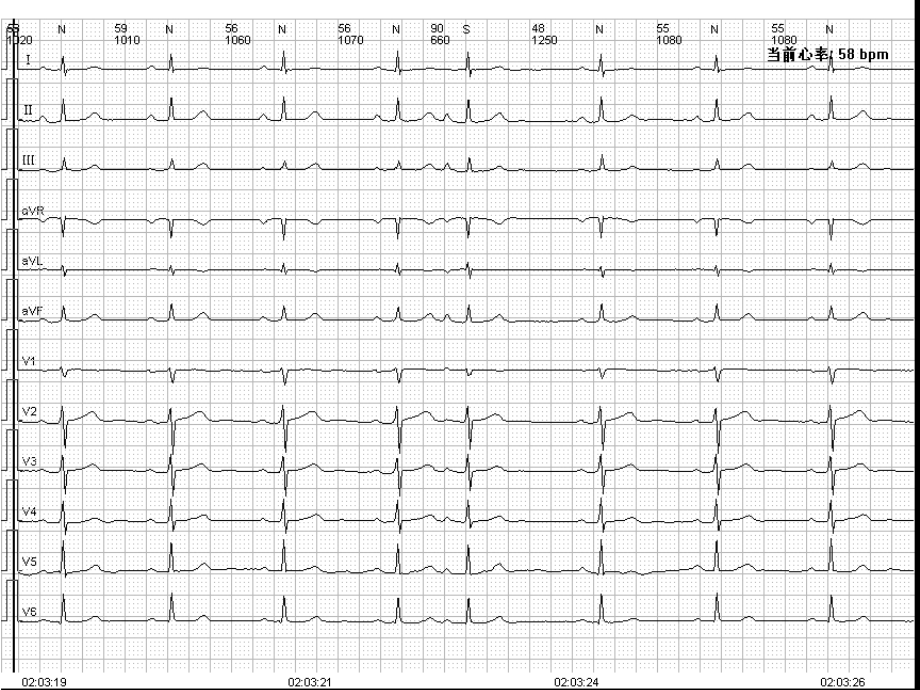 心电图常见波形及诊断.ppt_第2页