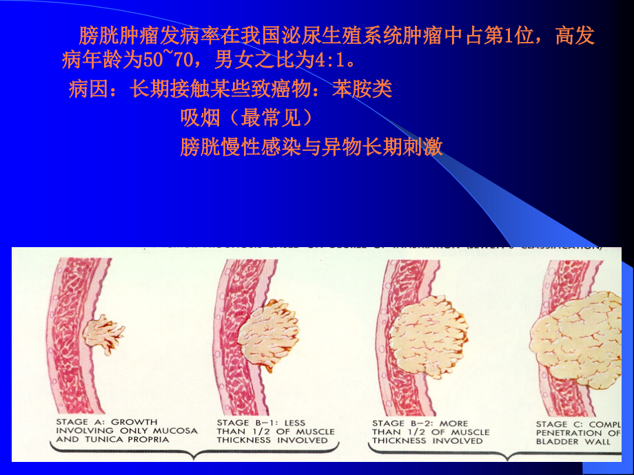 泌尿1：一例膀胱肿瘤患者护理查房资料.ppt_第3页