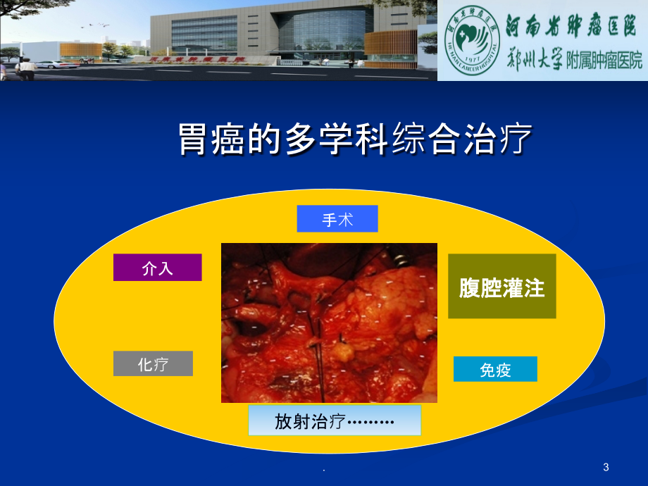 胃癌腹腔热灌注.ppt_第3页