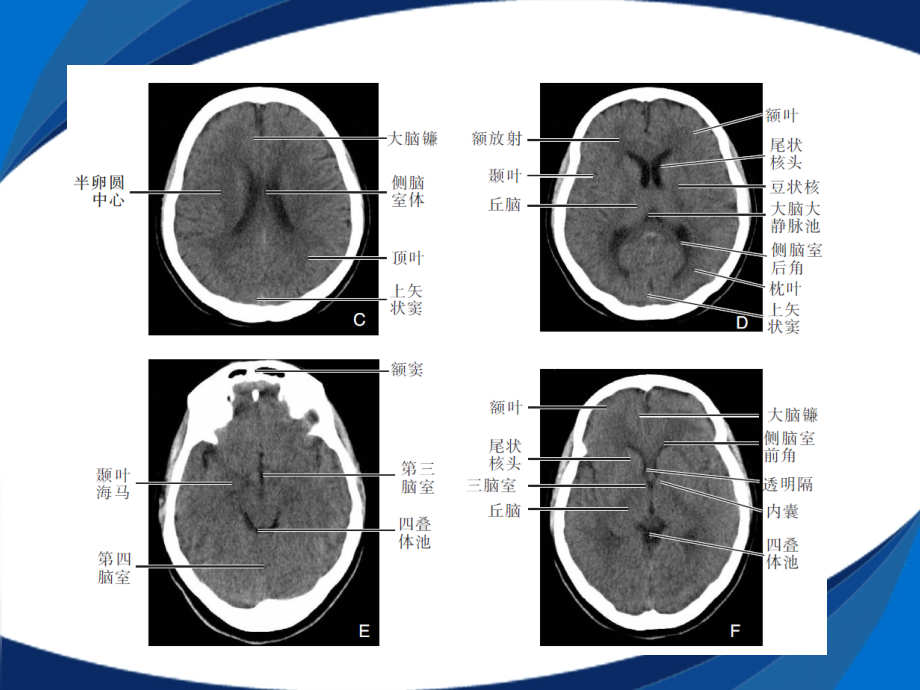颅脑CT诊断-.ppt_第3页