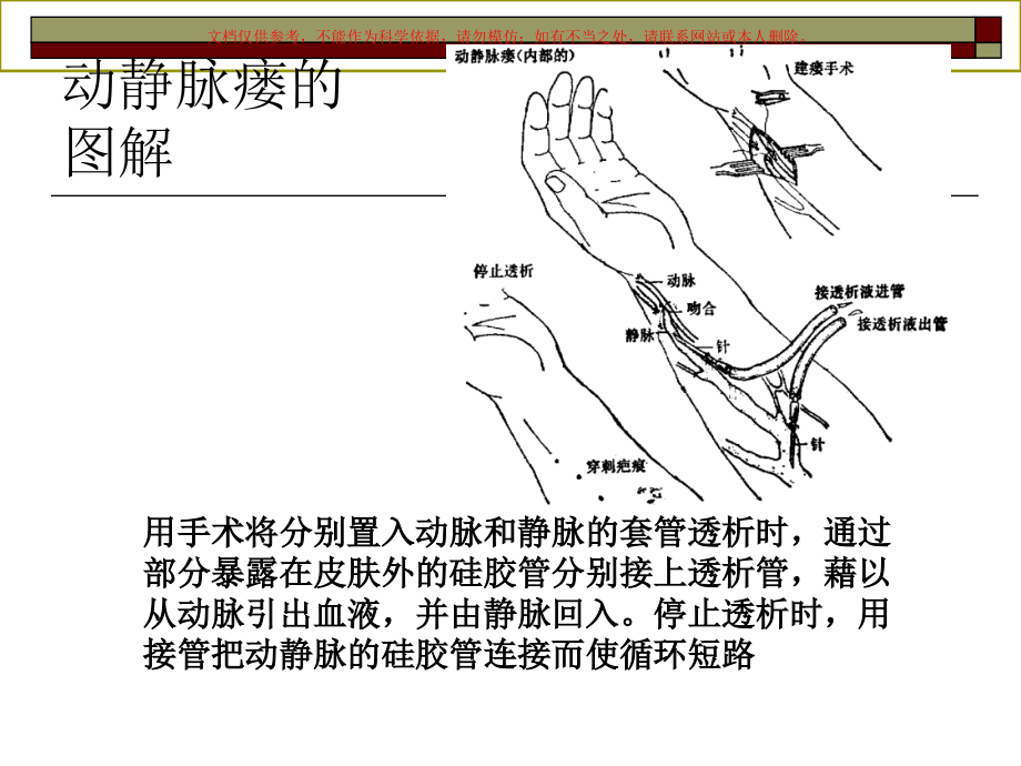 人工肾医学知识专题讲座培训课件.ppt_第3页