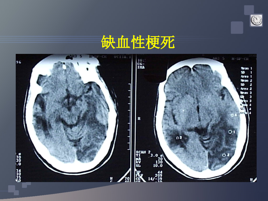 研究生医学影像学-颅脑.ppt_第3页