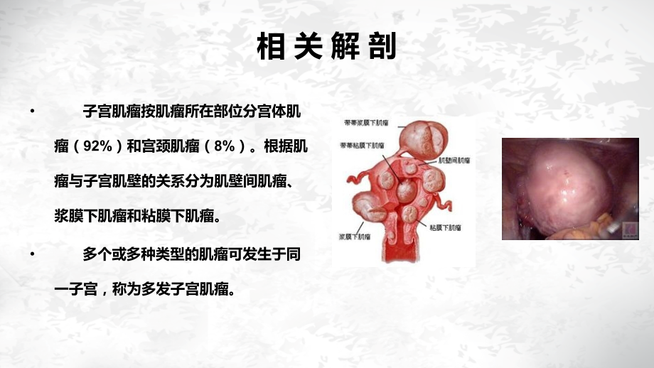 腹腔镜的下子宫肌瘤剔除术.ppt_第3页