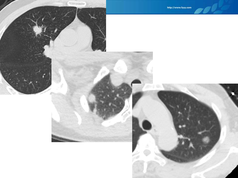 医学肺部结节的CT诊疗和处置方案.ppt_第2页