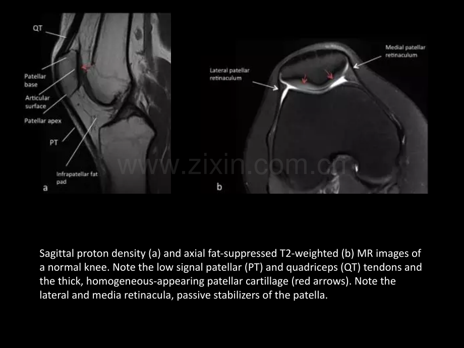 医学髌骨病变的影像学表现.ppt_第3页