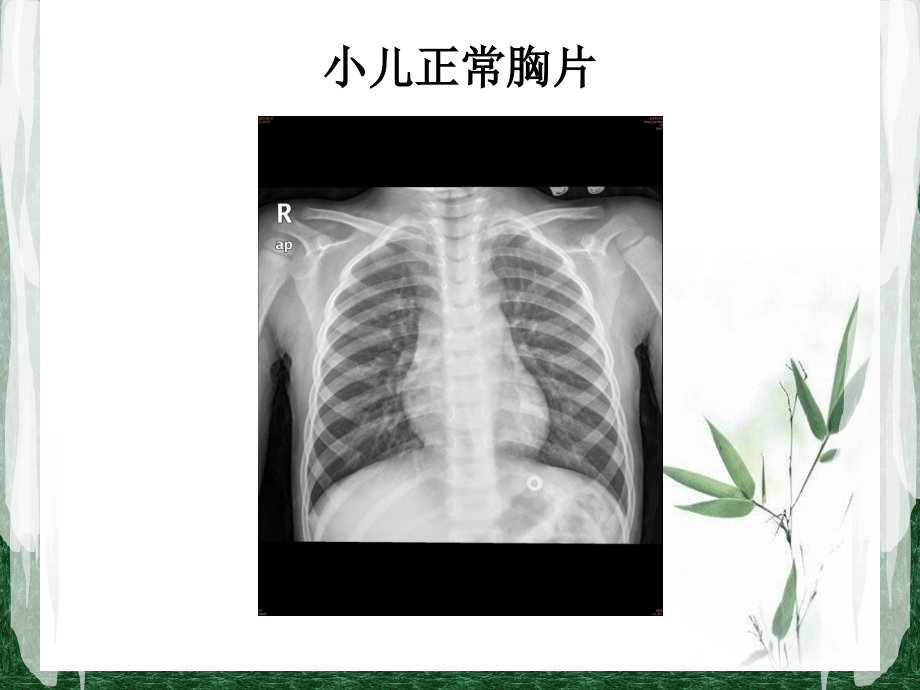 小儿肺炎胸片(医学PPT课件).ppt_第2页