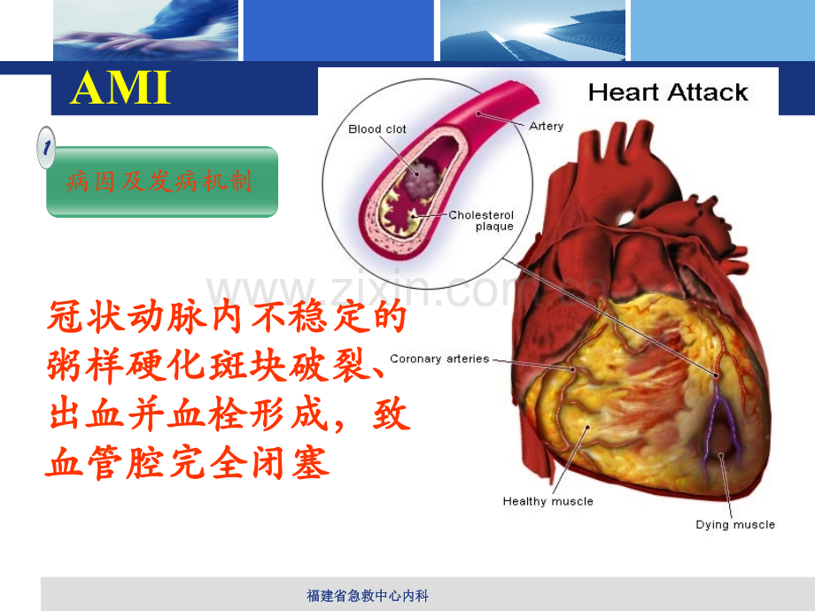 急性心肌梗死-PPT医学课件.ppt_第3页