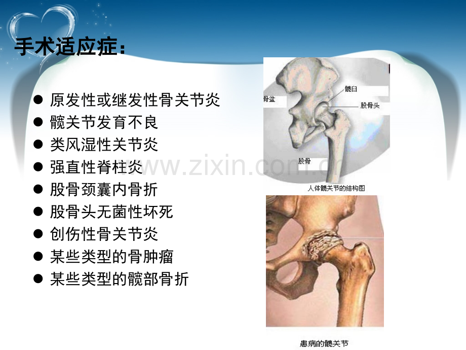 医学髋关节置换术后功能锻炼健康指导.ppt_第2页