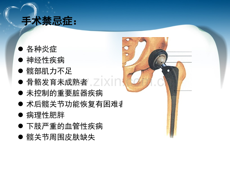 医学髋关节置换术后功能锻炼健康指导.ppt_第3页