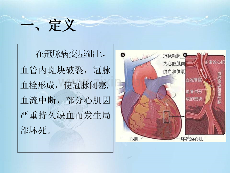 冠心病心肌梗死-.ppt_第2页