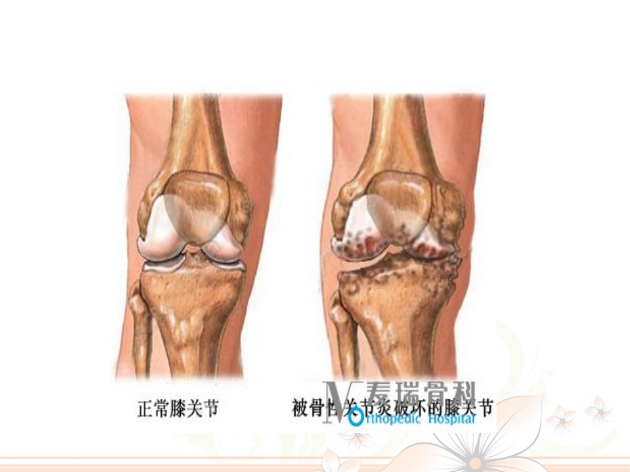 医学膝关节骨性关节炎的护理PPT.ppt_第3页