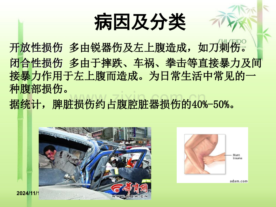 医学课件外伤性脾破裂的医疗护理查房宣讲.ppt_第3页