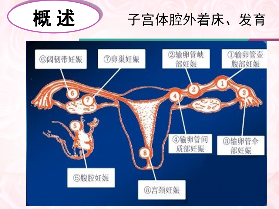 宫外孕失血性休克的护理专题PPT培训课件.ppt_第3页