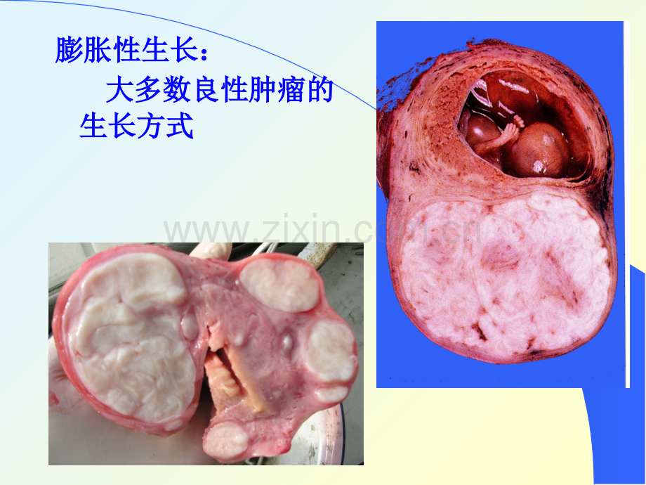 肿瘤的生长和转移.ppt_第3页